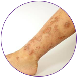 Treatment of eczema